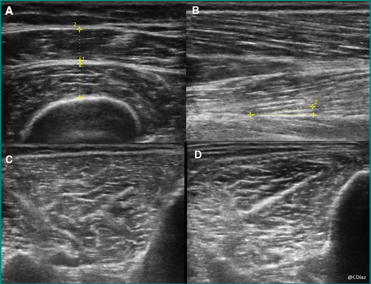 Exemple des évaluations musculaire par échographie
Image A : les lignes jaunes pointillés montrent la mesure de l’épaisseur du droit fémoral (n° 2) et vaste intermédiaire du quadriceps (n° 1)
Image B : exemple d’évaluation de l’angle de pennation formé par l’orientation des fibres musculaires par rapport à la fascia sous-jacent
Image C et D : différents niveaux d’échogénicité musculaire lors de l’évaluation du tibial antérieur